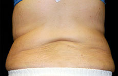 ヴァンキッシュMEの施術実績：腹部背面